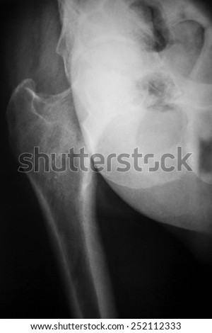 Film x-ray normal pelvis