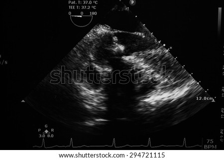 Screen of echo-cardiography (ultrasound) machine.