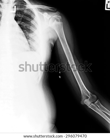 film x-ray normal shoulder and arm