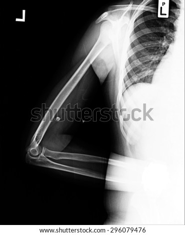 film x-ray normal shoulder and arm