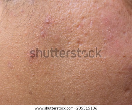Woman with oily skin and acne scars