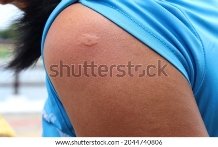 Skin allergy, allergic. hornet stings arm stung by a wasp worker. Yellow hornet stings arm. Imagine de stoc © 