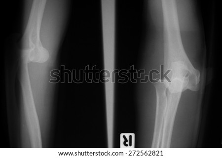 forearm x-rays image showing elbow dislocation