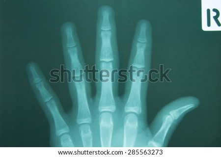 film x-ray hand AP : show normal human's hands on black background