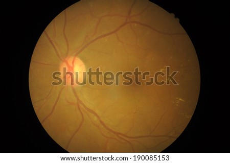 Disorders of sclera  Retinal picture ,Medical photo tractional (eye screen) retinal  detachment of diabetes