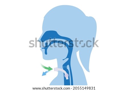 Surgical to inserted a siliconized tube into the Woman's neck and trachea to help breathe. Illustration about Medical to help a patient who can not breathe with nose and mouth.