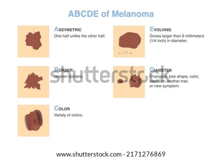 5 characteristics of skin damage of skin disease patient. Chart of ABCDE of melanoma (stands for asymmetry, border, color, diameter, and evolving)., For diagnosis and classification.