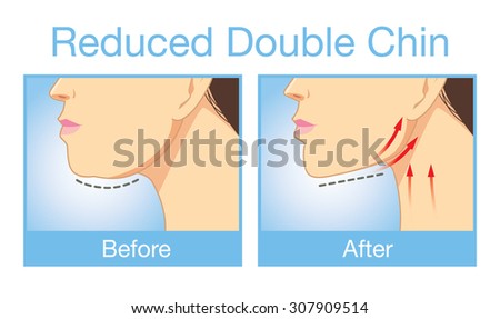 Illustration before and after procedure to reduce a double chin.
