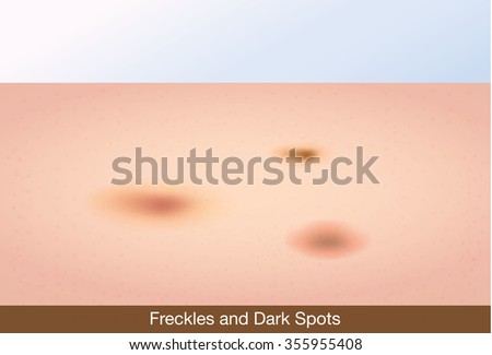 Freckles and dark spots on face skin. This illustration about skin care and beauty.