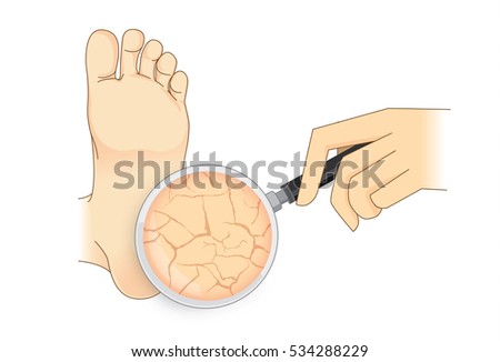 Zoom in cracked heel with magnifier on isolated. Illustration about beauty foot skin.