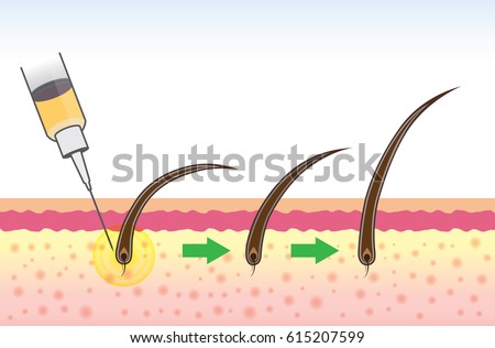 Hair follicle treatment of people have a hair loss problem with medical method.