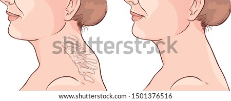 Woman Symptom Buffalo Hump Illustration Imagine de stoc © 