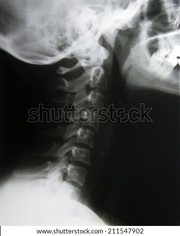 X-Ray Of The Neck Stock Photo 211547902 : Shutterstock