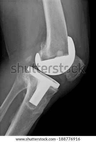 Xray imaging of bi compartmental knee prosthesis