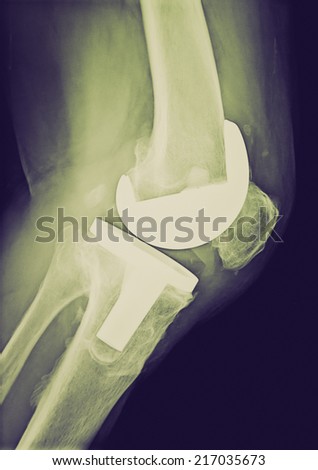Vintage looking Xray imaging of bi compartmental knee prosthesis