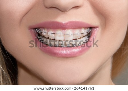Closeup Ceramic and Metal Braces on Teeth. Broad Smile with Self-ligating Brackets. Orthodontic Treatment. Woman Smiling Showing Dental Braces.