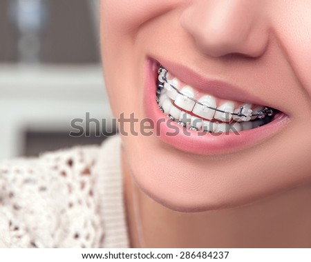 Braces. Orthodontic Treatment. Dental care Concept. Beautiful Woman healthy smile close up. Closeup Ceramic Braces on Teeth. Beautiful Female Smile with Braces.