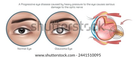 Glaucoma is a group of eye conditions that damage the optic nerve, which is essential for good vision, often due to increased pressure within the eye vector illustration.