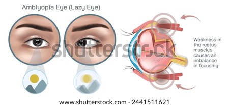 Amblyopia, often referred to as lazy eye is a condition characterized by reduced vision in one or both eyes that is not due to any structural abnormalities of the eye vector illustration.