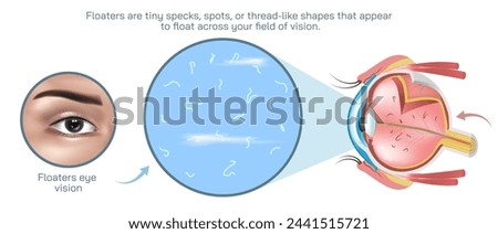 Floaters are small specks or particles that appear to float across your field of vision. They are most noticeable when you are looking at a plain background. eye syndrome and diseases vector.