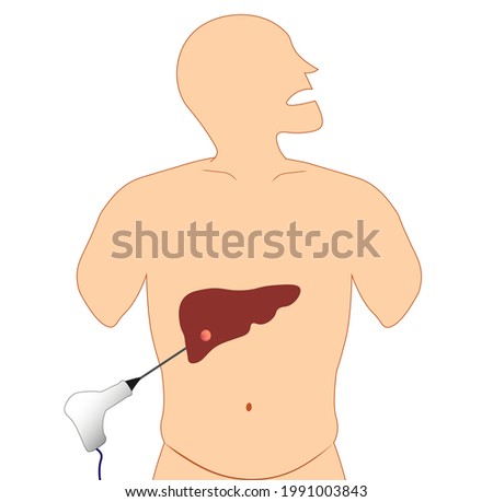 Liver Radiofrequency ablation (RFA) illustration. Liver cancer ablation. Needle ablation  Сток-фото © 