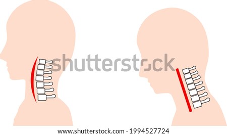 This is an illustration of a straight neck (text neck) and a normal neck bone.