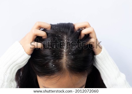 Dandruff problem. A girl with itchy head. Dandruff on the hair. Hair disease seborrhea. Fatty Dandruff. Stock foto © 