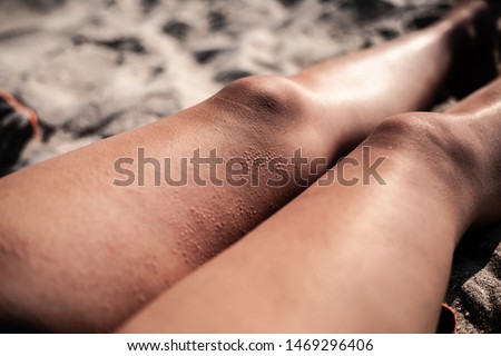 Similar – Image, Stock Photo skin allergies, hips skin women. Closeup of red pustules on a hips, an allergic reaction caused by atopic dermatitis. Selected focus