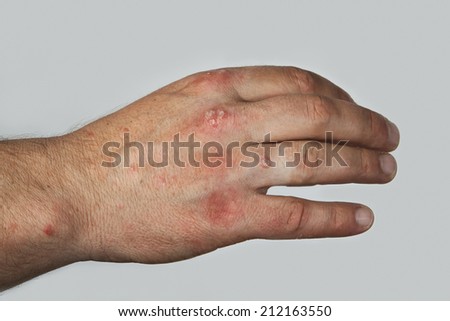 Severe Psoriasis On The Hand Stock Photo 212163550 : Shutterstock