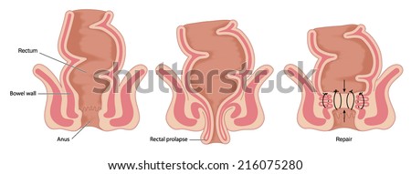 Rectal prolapse operation, showing normal bowel anatomy, prolapsed rectum and rectal repair. Created in Adobe Illustrator.  Contains transparencies.  EPS 10.