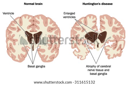 Normal brain and brain with Huntington's disease, showing enlarged ventricles and atrophy of nerve tissue and basal ganglia