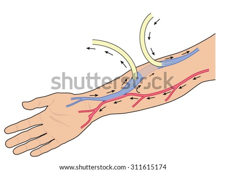 Fistula Popular Royalty-Free Vectors | Imageric.com