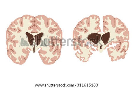 Normal brain and brain with Huntington's disease, showing enlarged ventricles and atrophy of nerve tissue and basal ganglia