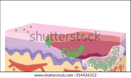 Growth of a bacterial biofilm on a skin wound, from initial attachment through microcolony formation, signalling and mature biofilm