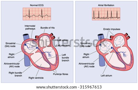 Drawing of the heart electrical conduction system showing normal activity and erratic impulses in atrial fibrillation.
