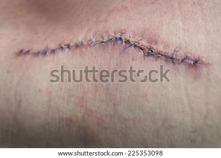 scar from operation suturated with a blue fiber
