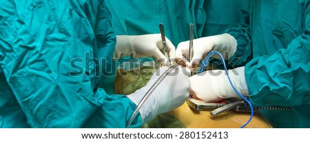 Surgeon hands during the open heart surgery