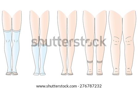 Legs There Is Edema, No Swelling Legs Stock Vector Illustration ...