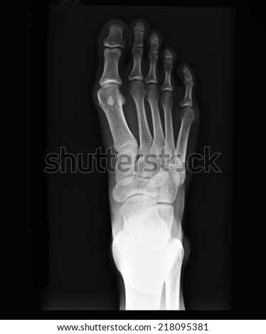 Human Foot Ankel And Leg Xray Picture Stock Photo 218095381 : Shutterstock