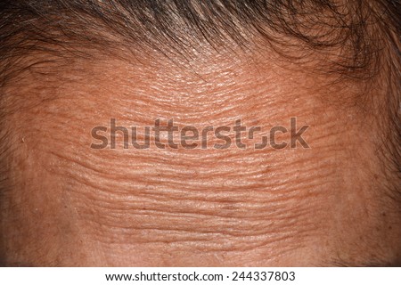 Wrinkled forehead