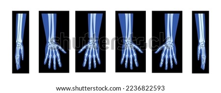 Set of X-Ray Hands with Radius, Ulna Skeleton Human body, Bones adult people roentgen front back side view. 3D realistic flat blue color concept Vector illustration of medical anatomy isolated
