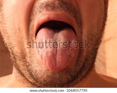 Geographic tongue (desquamative glossitis, benign migratory glossitis, exfoliative glossitis) is an inflammatory disease manifested by lesions on the back of the tongue and on its sides. Foto d'archivio © 