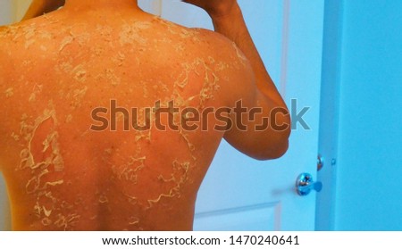 Peeling skin on human back also known as shedding or desquamation after over exposure to the summer sun and sunburn Foto d'archivio © 