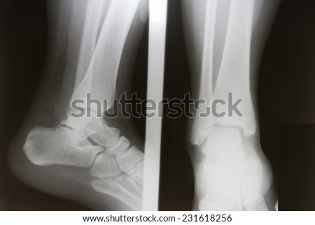 film x-ray ankle AP/Lateral : show fracture distal tibia and fibula (leg\'s bone) and ankle joint dislocation
