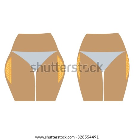 Fat thighs  before and after diet and fitness. Vector illustration on the white background.