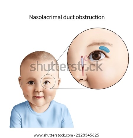 3d Medical illustration explaining nasolacrimal duct obstruction Photo stock © 