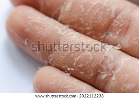 Peeling skin on hand and fingers. Desquamation Foto d'archivio © 