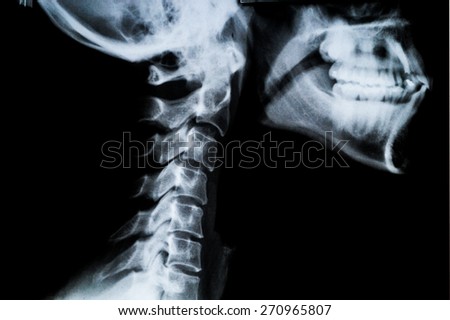 X ray of Human neck and Jaw