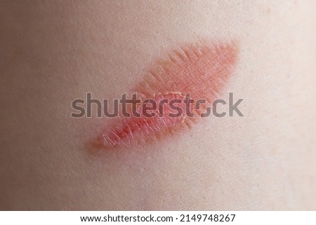 Similar – Image, Stock Photo Abrasion forearm Healthy