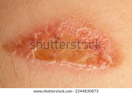 Image, Stock Photo Abrasion forearm Healthy